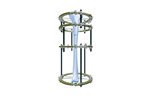 Distraction Osteogenesis Ring System